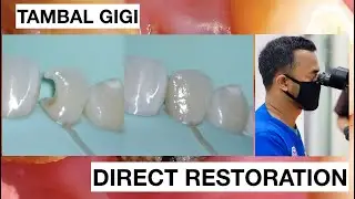 Class 3 with Direct Bonding Composite Restoration | General Dentist Griya RR