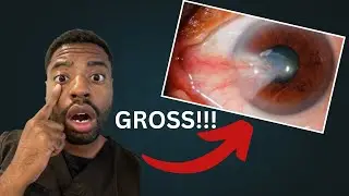 Pink flesh on your eye? it&rsquo;s called Pterygium. (Here&rsquo;s what you should&rsquo;ve done.)