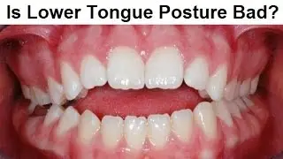 Why Tongue Can`t Stay Touching Lower Front Teeth by Prof John Mew