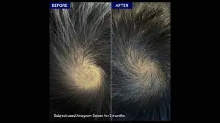 Anagrow Hair Serum. Restores Hair | Make Hair Thicker. #communitypharmacist