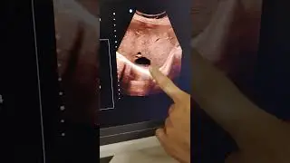 Hepatic cyst in right lobe of liver