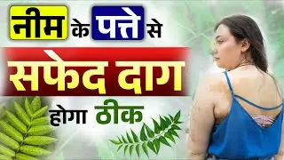 नीम के पेस्ट से मिलेगा सफेद दाग से छुटकारा | Best Home Remedies For Vitiligo | Bharat Homeopathy