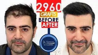 Dr Resul Yaman Hair Clinic - 2960 Grafts - 10 Months Result