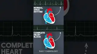 Normal Sinus Rhythm & Complete Heart Block (ECG vs Animation) #shorts #heartblock #cardiology