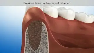 Extracted tooth without ridge preservation