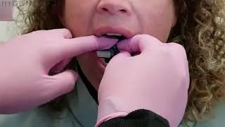 Digital Dental Bitewing Tips