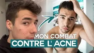COMMENT JE ME SUIS ENFIN DÉBARRASSÉ DE MON ACNÉ ! (Curacné...)
