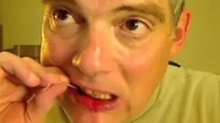 t28 - bicuspid - 2-FREE Perio Abscess - w brush-pick - post curettage - PART-2