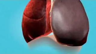 Emphysema and endobronchial valve treatment