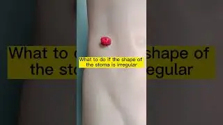 In addition to filling the irregular shape of the stoma with anti-leakage paste