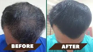 STOP HAIRFALL|HAIR LOSS TREATMENT FOR MEN|HAIR REGROWTH - 