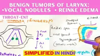 Benign Tumors of Larynx: Vocal Nodules & Reinke Edema | हिन्दी | ENT | 