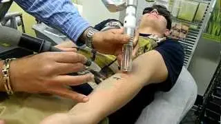 multiple laser tatoo removal with 20 min interval instant laser clinic