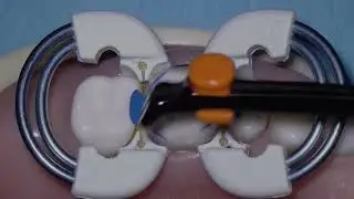 How to use the new Bioclear Adjustable Push Pull Instrument