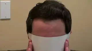 Full Hair Restoration Results After Bay Area Hair Transplant Treatment