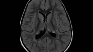 Tuberous Sclerosis