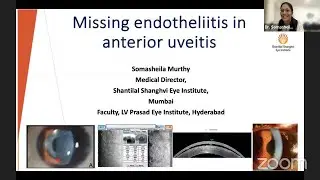 Dr. Somasheila Murthy - Missing Endothelitis in anterior uveitis
