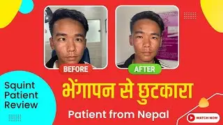 Strabismus Surgery Or Squint Surgery Treatment Or Crossed Eyes Happy Squint patient from Nepal