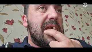 4 days before immediate dentures