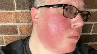 Video 14 - Reality Check: Living on Fire with Erythromelalgia & Anhidrosis.
