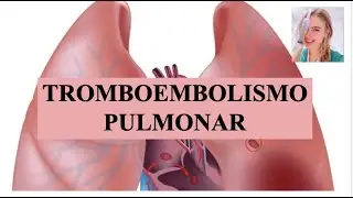 TROMBOEMBOLISMO PULMONAR (TEP): FISIOPATO, FACTORES DE RIESGO, SÍNTOMAS, DIAGNÓSTICO Y TRATAMIENTO