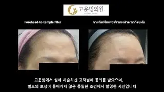Natural sheen, elegant vibe Forehead & temple filler