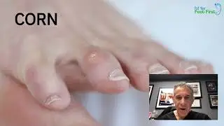 Custom Orthotics for Callus Corn