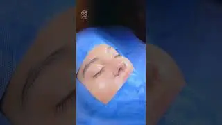 Your Ideal Profile Awaits😍Rhinoplasty👃 at Vive Plastic Surgery #tijuana