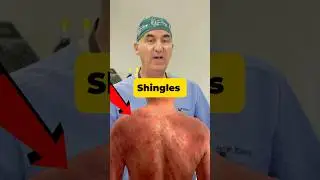 Shingles - You Don't Want This! #shorts