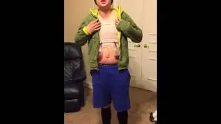 FTM Top Surgery: 1 day post op!