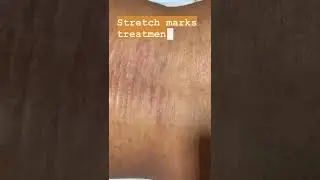 Stretch mark removal/stretch  mark removal laser/dermatologist surat