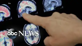 FDA permits marketing of diagnostic test for Alzheimer's disease