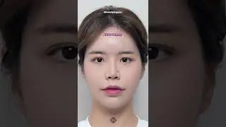 6 months after double jaw surgery in Korea!