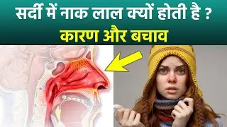Red Nose In Winter: ठंड में नाक लाल क्यों हो जाती है, Causes & Treatment In Hindi|Boldsky
