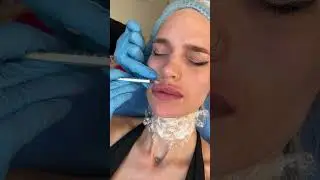 5 мл гиаулороновой кислоты вколола в губы 👄
