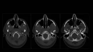 Sino nasal Imaging   Dr Mamdouh Mahfouz 720p