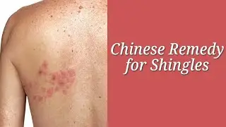 Chinese Remedies for Relieving Shingles
