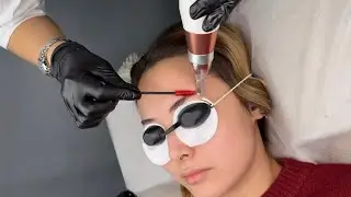Red eyebrow tattoo removal process (27)