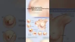 New Hope for Breast Cancer Patients | Modern Oncoplastic Surgery