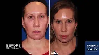 Ultherapy Treatment with Before & Afters