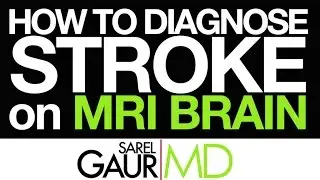 How to Diagnose Stroke on MRI Brain