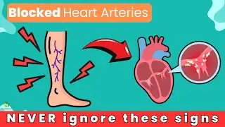 6 Warning Signs of Blocked Heart Arteries in Legs