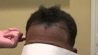 African American Man Receding Corners Hair Loss Transplant Surgery Dr. Diep www.mhtaclinic.com