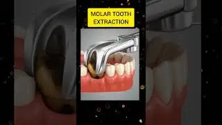 Molar tooth extraction 3D Animation video .. #dentist #dental #dentalcare #dentistry #shorts #teeth