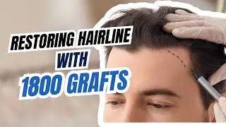 Restoring #hairline with 1800 grafts at @novamedicalhairtransplant