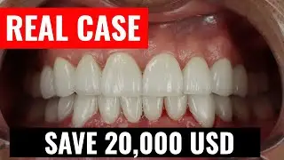 ✔️ Full Mouth Rehabilitation in Tijuana, Mexico