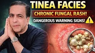 TOPIC # 113 (TREATMENT OF RING WORM OF FACE AND BODY).