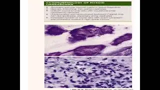 Soft tissue tumors 
