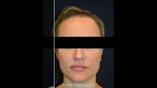 Dr. Champagne - Hairline Lowering Before & After