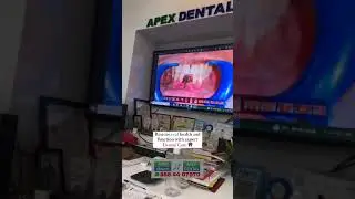 @apexdentalhospitalresearch1286 #fibrosis #mouthopen #mouthopen #osmf #gutka #osmf